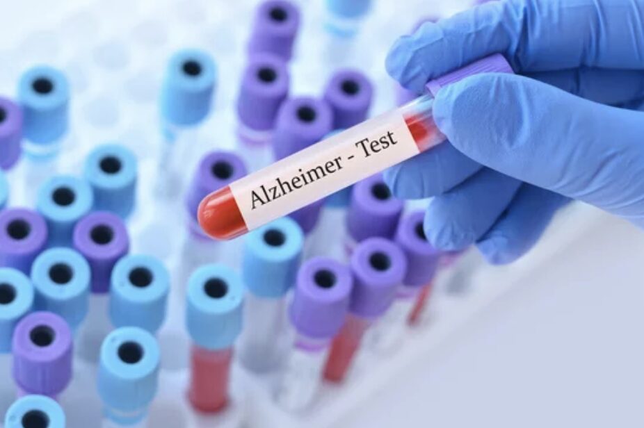 Exame para Alzheimer custa até R$ 5 mil no Brasil